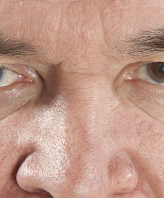 Jakie są przyczyny zaćmy wtórnej